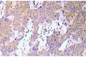 Immunohistochemistry (IHC) analyzes of NFkB-p65 pAb in paraffin-embedded human lung adenocarcinoma tissue. (NF-kB p65 anticorps)