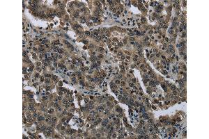 Immunohistochemistry of Human liver cancer using FTO Polyclonal Antibody at dilution of 1:60 (FTO anticorps)