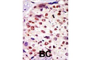 Formalin-fixed and paraffin-embedded human breast cancer tissue reacted with BAI1 polyclonal antibody  , which was peroxidase-conjugated to the secondary antibody, followed by AEC staining. (BAI1 anticorps  (C-Term))