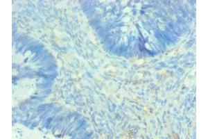 Immunohistochemical of paraffin-embedded human breast cancer using ABIN7143609 at dilution of 1:200