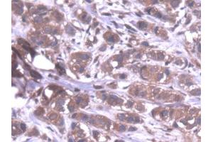 DAB staining on IHC-P; Samples: Human Breast cancer Tissue (PPP1CA anticorps  (AA 2-330))