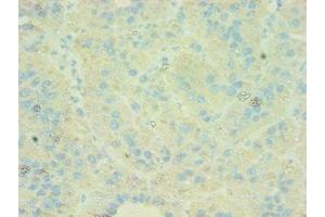 Immunohistochemistry of paraffin-embedded human liver cancer using ABIN7146169 at dilution of 1:100