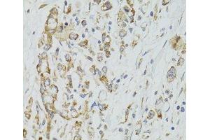 Immunohistochemistry of paraffin-embedded Human gastric cancer using DICER1 Polyclonal Antibody at dilution of 1:100 (40x lens). (DICER1 anticorps)