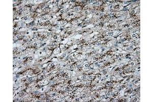 Immunohistochemical staining of paraffin-embedded Carcinoma of liver tissue using anti-ERCC1 mouse monoclonal antibody. (ERCC1 anticorps)