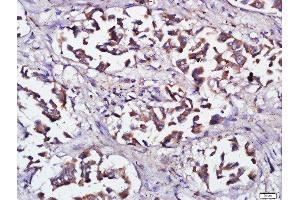 Paraformaldehyde-fixed, paraffin embedded human lung cancer, Antigen retrieval by boiling in sodium citrate buffer (pH6) for 15min, Block endogenous peroxidase by 3% hydrogen peroxide for 30 minutes, Blocking buffer (normal goat serum) at 37°C for 20min, Antibody incubation with RNF138 Polyclonal Antibody, Unconjugated  at 1:500 overnight at 4°C, followed by a conjugated secondary and DAB staining.