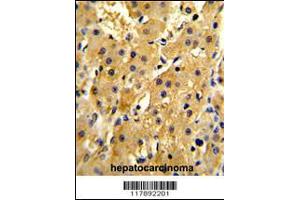 Formalin-fixed and paraffin-embedded human hepatocarcinoma reacted with HPD Antibody (N-term), which was peroxidase-conjugated to the secondary antibody, followed by DAB staining. (HPD anticorps  (N-Term))