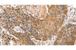 Immunohistochemistry of paraffin-embedded Human esophagus cancer using STX10 Polyclonal Antibody at dilution of 1:45 (Syntaxin 10 anticorps)