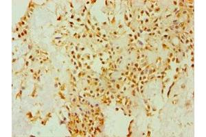 Immunohistochemistry of paraffin-embedded human breast cancer using ABIN7149658 at dilution of 1:100