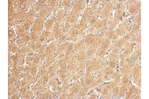IHC-P Image UGDH antibody detects UGDH protein at cytosol on human hepatoma by immunohistochemical analysis.