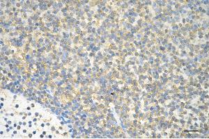 Immunohistochemistry was performed on paraffin-embedded human lymphoma using GRK2 antibody (ABIN7797538), 1:200).