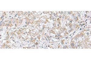 Immunohistochemistry of paraffin-embedded Human liver cancer tissue using CGB5 Polyclonal Antibody at dilution of 1:55(x200) (CGB5 anticorps)
