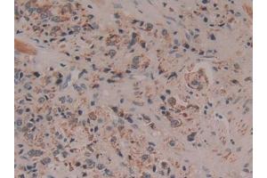 Detection of CYCS in Human Prostate cancer Tissue using Polyclonal Antibody to Cytochrome C (CYCS)