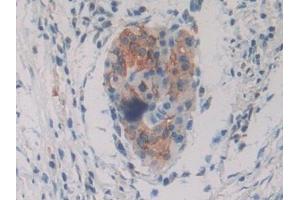 Detection of PKIg in Human Pancreatic cancer Tissue using Polyclonal Antibody to Protein Kinase Inhibitor Gamma (PKIg) (PKIG anticorps  (AA 1-76))