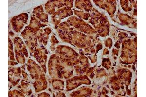 IHC image of ABIN7169703 diluted at 1:400 and staining in paraffin-embedded human pancreatic cancer performed on a Leica BondTM system.