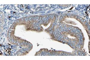 ABIN6279733 at 1/100 staining Human cervical cancer tissue by IHC-P. (RAB24 anticorps  (Internal Region))