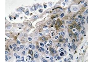 Immunohistochemistry analysis of IL-1B Antibody in paraffin-embedded human lung carcinoma tissue. (IL-1 beta anticorps)