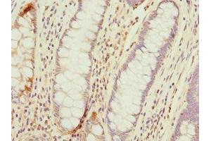 Immunohistochemistry of paraffin-embedded human colon cancer using ABIN7172974 at dilution of 1:100 (TMED1 anticorps  (AA 35-190))