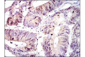 Figure5: Immunohistochemical analysis of paraffin-embedded colon cancer tissues using PBK mouse mAb with DAB staining. (PBK anticorps)
