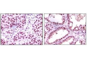 Immunohistochemical analysis of paraffin-embedded human lung carcinoma (left) and kidney carcinoma (right), showing nuclear localization using LSD1 mouse mAb with DAB staining.