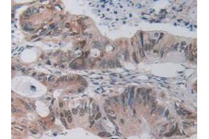 IHC-P analysis of Mouse Rectum Cancer Tissue, with DAB staining. (FLIP anticorps  (AA 210-460))