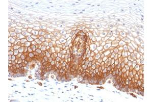Formalin-fixed, paraffin-embedded human Cervical Carcinoma stained with Thrombomodulin/CD141 Monoclonal Antibody (THBD/1591).