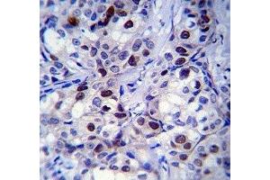 Rb antibody immunohistochemistry analysis in formalin fixed and paraffin embedded human breast carcinoma. (Retinoblastoma Protein (Rb) anticorps  (AA 586-615))