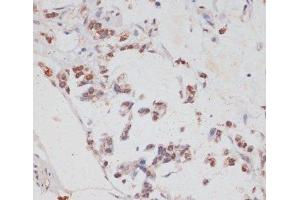 Immunohistochemistry of paraffin-embedded Human gastric cancer using HTATSF1 Polyclonal Antibody at dilution of 1:100 (40x lens). (HTATSF1 anticorps)