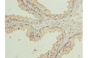 Immunohistochemistry of paraffin-embedded human prostate cancer using ABIN7175806 at dilution of 1:100 (WDR91 anticorps  (AA 1-747))
