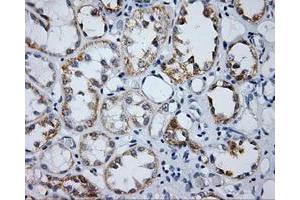 Immunohistochemical staining of paraffin-embedded Carcinoma of prostate tissue using anti-LIPG mouse monoclonal antibody. (LIPG anticorps)
