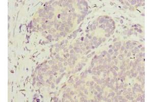Immunohistochemistry of paraffin-embedded human gastric cancer using ABIN7175802 at dilution of 1:100 (WDR89 anticorps  (AA 1-387))
