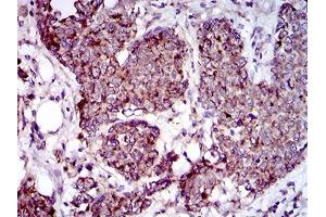 Immunohistochemical analysis of paraffin-embedded breast cancer tissues using MRPL42 mouse mAb with DAB staining. (MRPL42 anticorps  (AA 10-142))