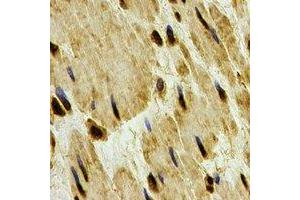 Immunohistochemical analysis of PP1 beta staining in human esophageal cancer formalin fixed paraffin embedded tissue section.