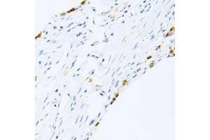 Immunohistochemistry of paraffin-embedded human lung using SFTPC antibody. (Surfactant Protein C anticorps)