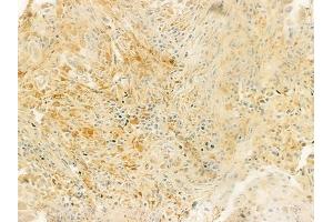 ABIN6263748 and ABIN6279343 at 1/100 staining human lung squamous cell carcinoma by IHC-P. (NT5C2 anticorps  (Internal Region))