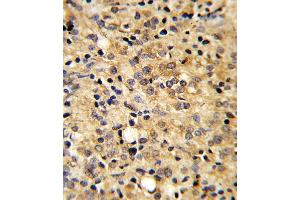 Formalin-fixed and paraffin-embedded human prostate carcinoma reacted with CO Antibody (Center), which was peroxidase-conjugated to the secondary antibody, followed by DAB staining.