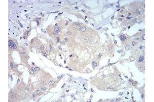 Immunohistochemical analysis of paraffin-embedded liver cancer tissues using FOXP3 mouse mAb with DAB staining.