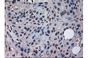Immunohistochemical staining of paraffin-embedded Adenocarcinoma of breast tissue using anti-MRI1 mouse monoclonal antibody. (MRI1 anticorps)