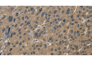 Immunohistochemistry of paraffin-embedded Human liver cancer using CORO1C Polyclonal Antibody at dilution of 1:60