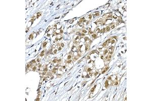 Immunohistochemistry of paraffin-embedded human breast cancer using SNRPD1 Rabbit pAb (ABIN7270363) at dilution of 1:50 (40x lens). (SNRPD1 anticorps  (AA 1-100))