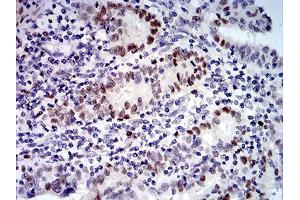Immunohistochemical analysis of paraffin-embedded endometrial cancer tissues using UFD1L mouse mAb with DAB staining.