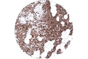 Parathyroid Strong cytoplasmic PTH immunostaining of all cells of a parathyroid gland