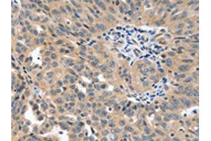 The image on the left is immunohistochemistry of paraffin-embedded Human ovarian cancer tissue using ABIN7191763(P2RY6 Antibody) at dilution 1/40, on the right is treated with synthetic peptide.