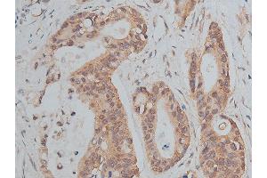 ABIN6266511 at 1/50 staining human colon cancer tissue sections by IHC-P.