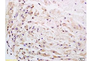 Formalin-fixed and paraffin embedded human gastric carcinoma labeled with Anti-Wnt1 Polyclonal Antibody, Unconjugated (ABIN733748) at 1:200 followed by conjugation to the secondary antibody and DAB staining. (WNT1 anticorps  (AA 251-350))