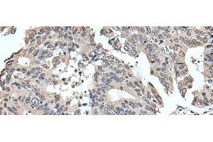 Immunohistochemistry of paraffin-embedded Human colorectal cancer tissue using TRIM23 Polyclonal Antibody at dilution of 1:55(x200)