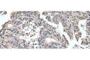 Immunohistochemistry of paraffin-embedded Human colorectal cancer tissue using TRIM23 Polyclonal Antibody at dilution of 1:55(x200) (TRIM23 anticorps)