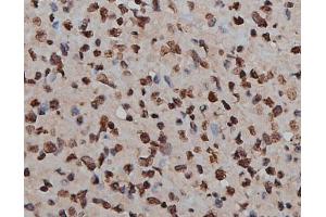 ABIN6269160 at 1/200 staining human lymph cancer tissue sections by IHC-P. (H2AFX anticorps)