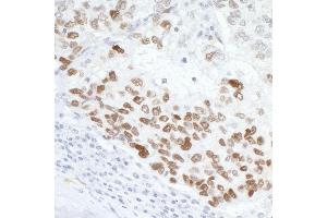 Immunohistochemistry (IHC) image for anti-Tumor Protein P53 (TP53) (AA 50-100) antibody (ABIN7454600) (p53 anticorps  (AA 50-100))