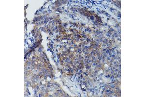 Immunohistochemistry of paraffin-embedded human cervix cancer using BSG Rabbit pAb (ABIN3022146, ABIN3022147, ABIN1512647 and ABIN6218629) at dilution of 1:100 (40x lens).
