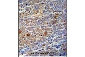 C9orf156 Antibody (C-term) (ABIN390925 and ABIN2841127) immunohistochemistry analysis in formalin fixed and paraffin embedded human skin carcinoma followed by peroxidase conjugation of the secondary antibody and DAB staining. (C9orf156 anticorps  (C-Term))